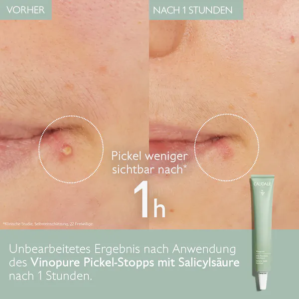 Vinopure Pickel Stopp mit Salicylsäure 15ml Vinopure Pickel Stopp mit Salicylsäure 15ml